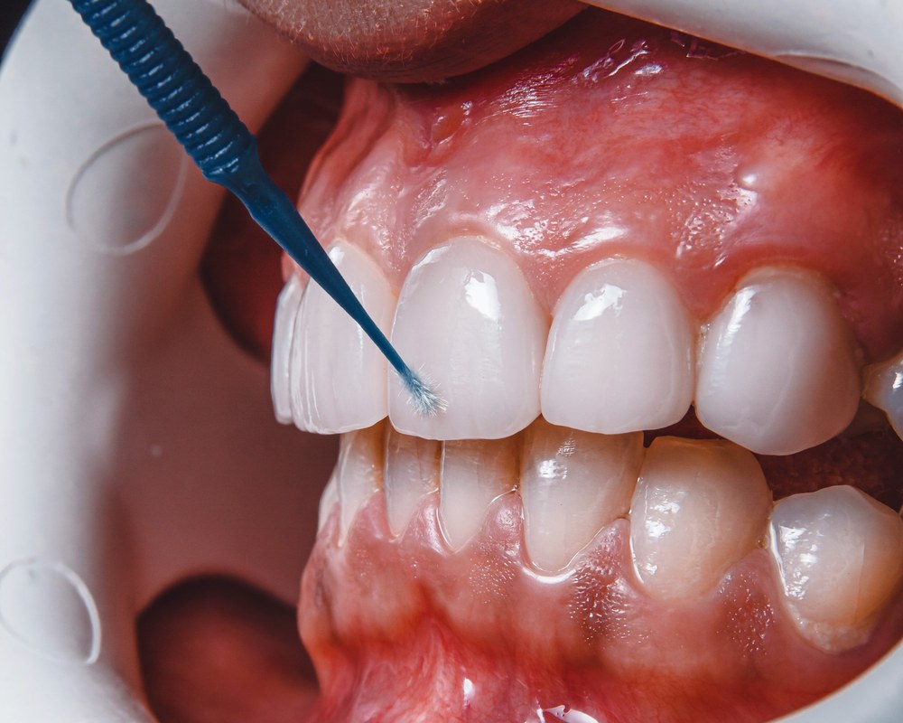 Izbeljivanje zuba — Sano Dental & Aesthetic, Kragujevac