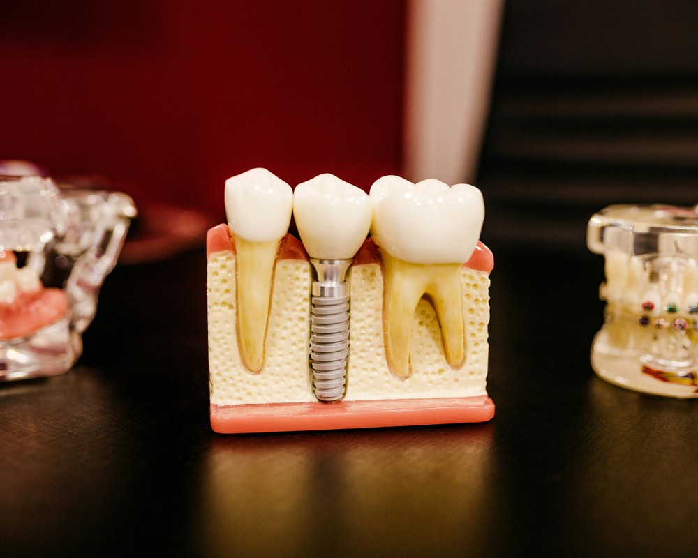 Nedostatak zuba — Sano Dental & Aesthetic, Kragujevac