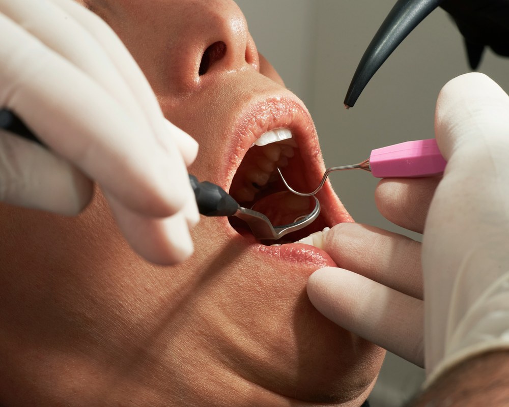 Tretiranje parodontoze — Sano Dental & Aesthetic, Kragujevac